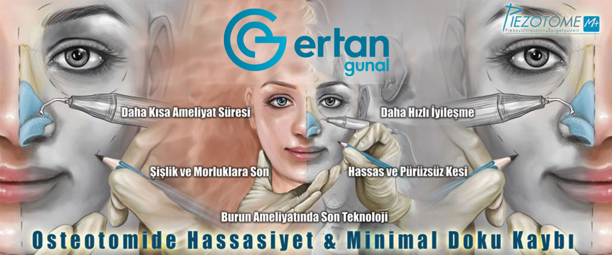 Piezo Burun Estetiği Ertan Günal Piezo Burun Estetiği Ertan Günal