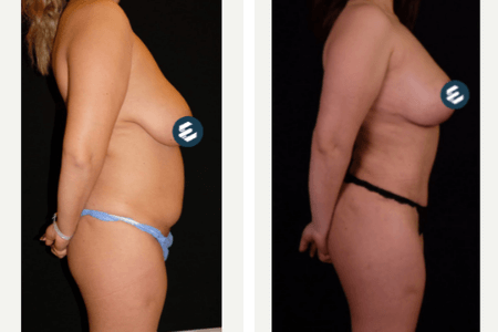 mommy-makeover-before-and-after